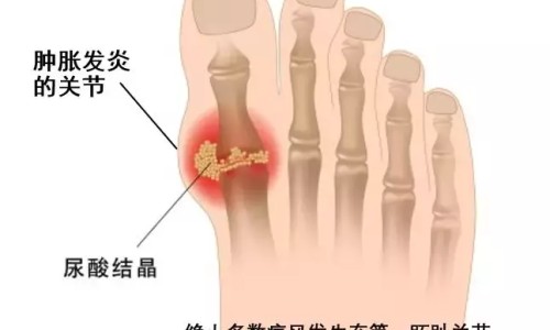 病人女51岁子宫肌瘤切除术后护理措施-57岁子宫肌瘤全切除一年后总生气有影响吗,中国病人女51岁子宫肌瘤切除术后网站